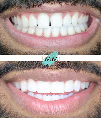 Composite Bonding Case
