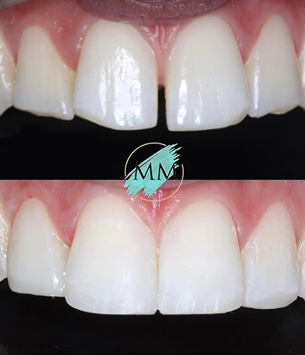 Composite Bonding Case