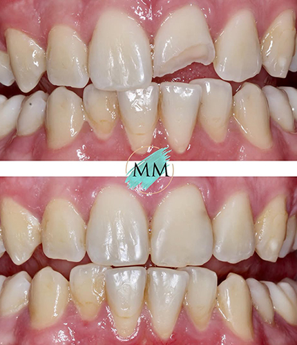 Composite Bonding Case