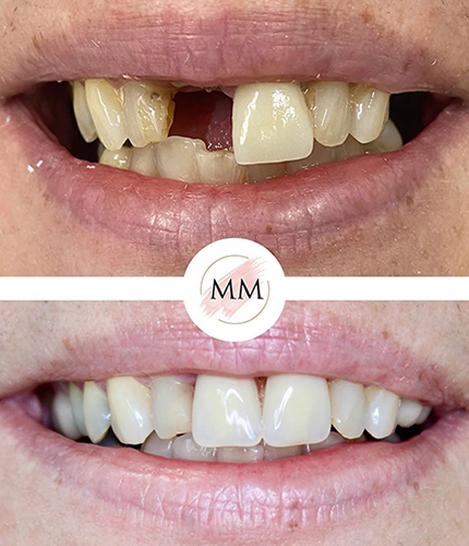 Dental Implants Case