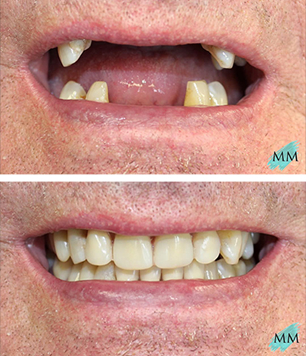 Dental Implants Case