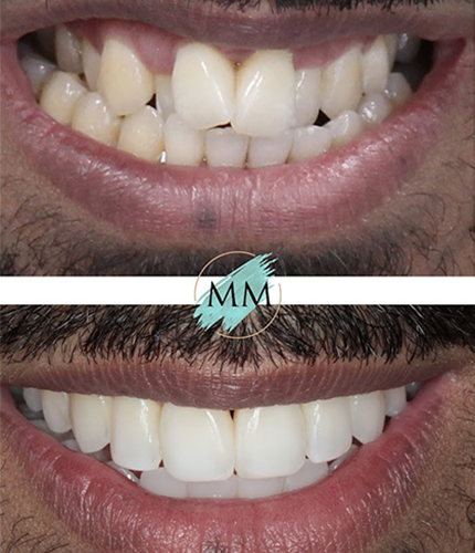 Smile Makeover Case