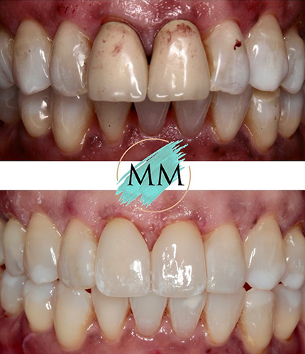 Smile Makeover Case