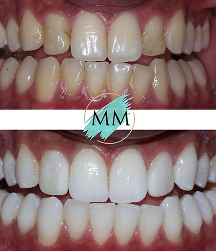 Smile Makeover Case