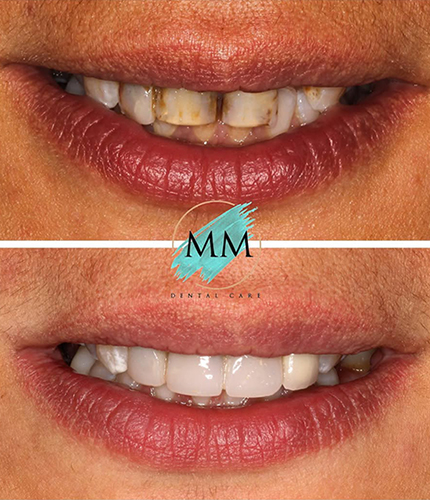 Smile Makeover Case