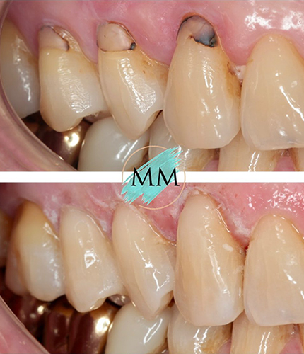 White Fillings Case