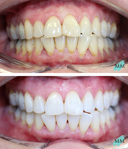 Tooth Whitening Case
